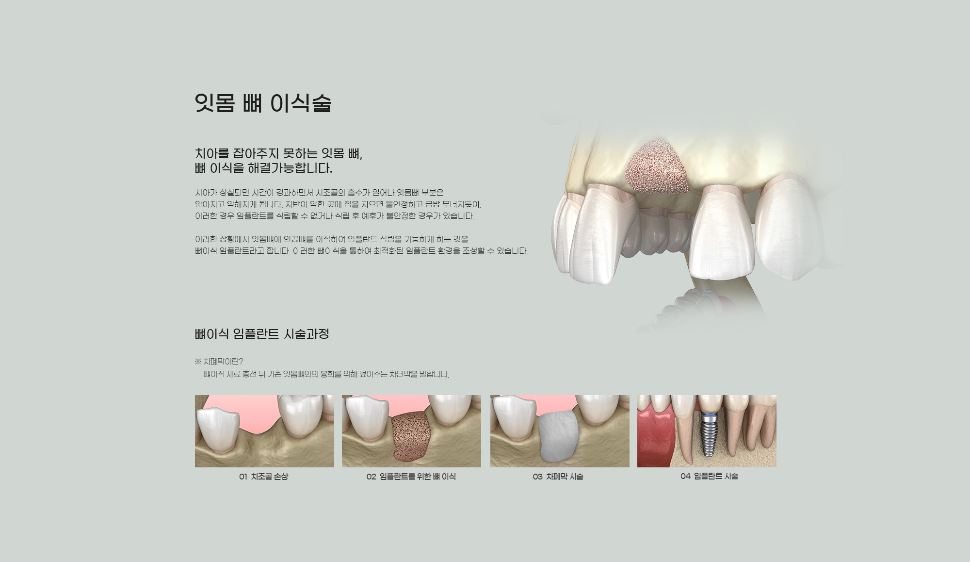 잇몸뼈 이식술