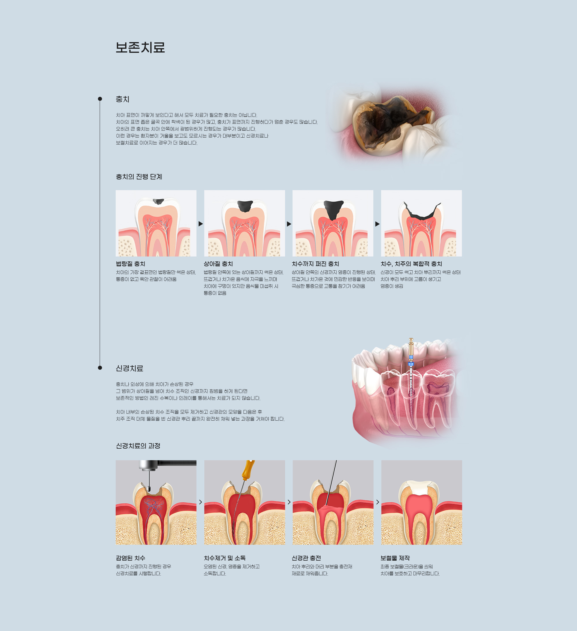 보존치료